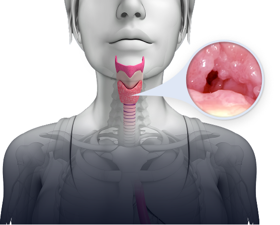 Throat showing recurrent
respiratory papillomatosis (RRP)
growths in the airway.